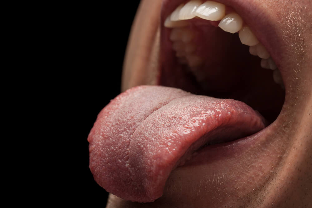 lengua agrietada