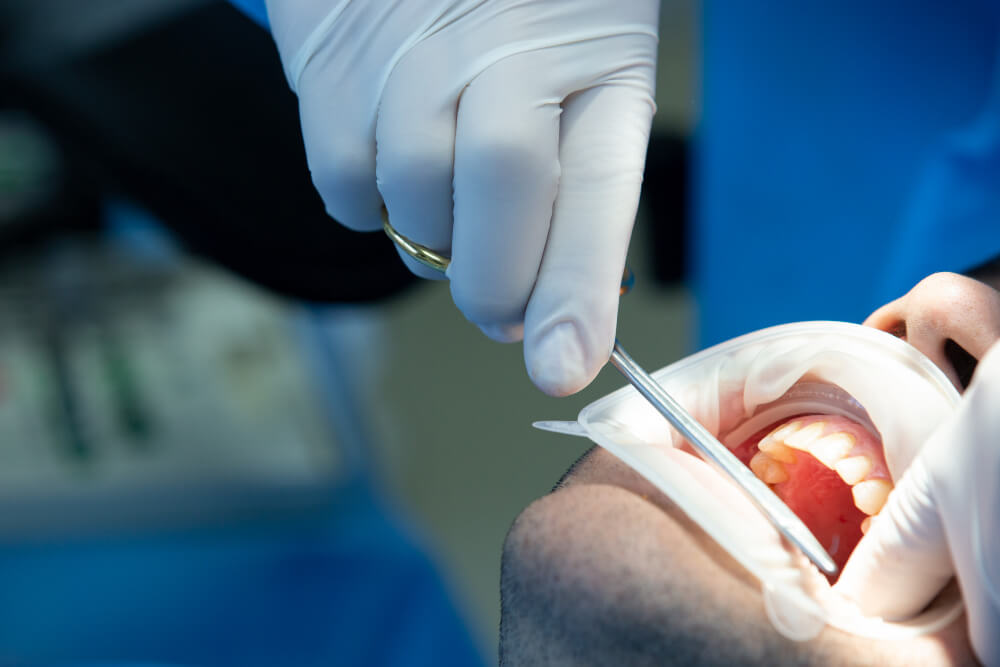 Implantes Corticales